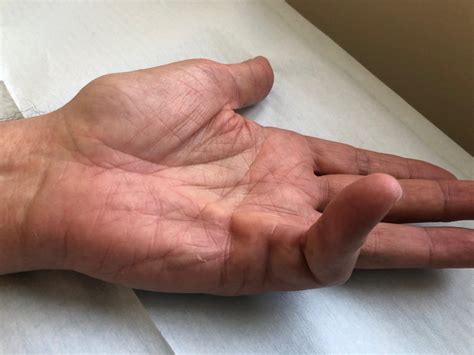 Behandeling voor Dupuytren - Dupuytren Specialist
