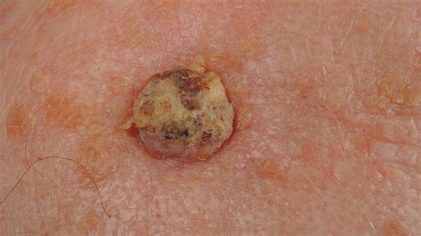 How To Prevent Squamous Cell Carcinoma - Forcesurgery24