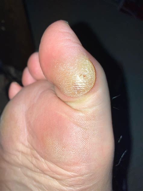 Bunion or callus on big toe? : r/bunions