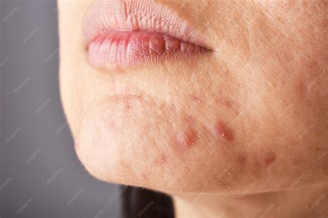 premium photo skin problem  acne diseases close  woman face
