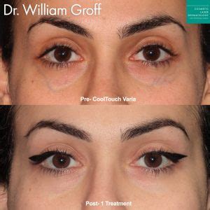 how to get rid of veins under eyes