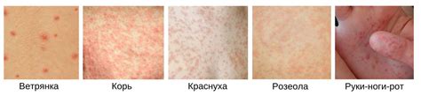 Как выглядит сыпь при менингите фото