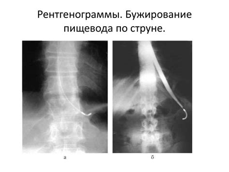 Хирургическая тактика при стенозах пищевода - презентация онлайн