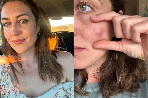 Cyst On Chin Removal