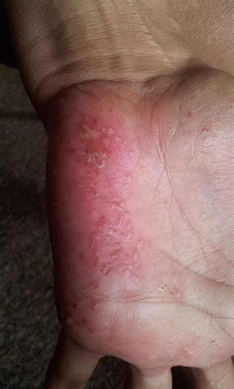 Weiße Bläschen auf den Händen. Was ist das? (Gesundheit und Medizin ...
