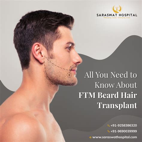 All You Need to Know About FTM Beard Hair Transplant