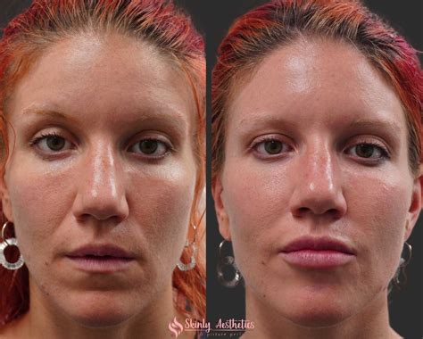 Smile Line Fillers - Before & After Results at Skinly