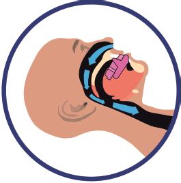Купить капу от храпа в Москве: стоматологическая капа Dental Sleep