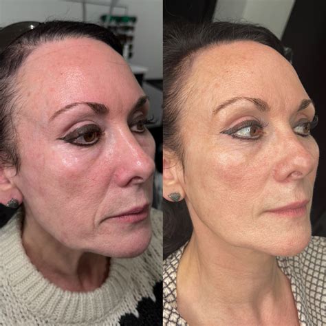 Polynucleotide Treatment | Salmon Sperm Facial | Faces By Bae