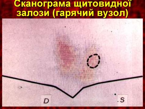 Захворювання щитоподібної залози - презентация онлайн