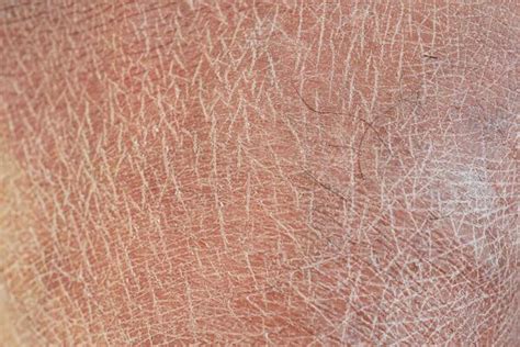 Dead Skin Stock Photos, Images and Backgrounds for Free Download