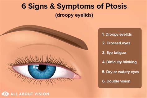 ptosis droopy eyelids   vision