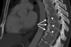 Osteochondropathy of the spine: symptoms, diagnosis, treatment