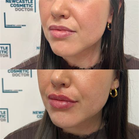 Pin by Newcastle Cosmetic Doctor on Lip filler | Lip fillers, Lips, Filler