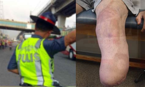 Pulis trapiko naputulan ng paa sa bus vs Auv – Abante Tonite