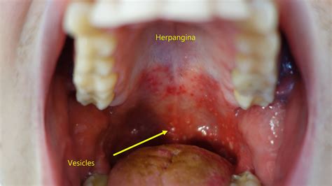 Herpangina - wikidoc