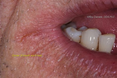 Angular Cheilitis Candida