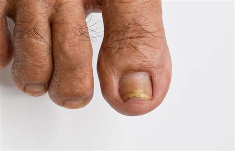 Premium Photo | Fungal nail infection Onychomycosis also called Tinea ...