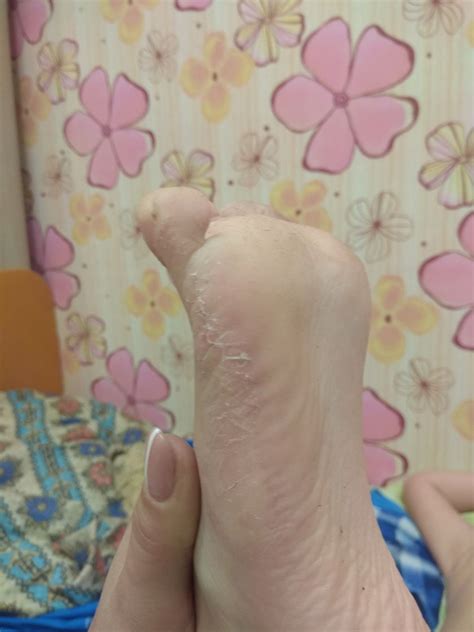 Кожа между пальцами ног шелушится: Трескается кожа на пальцах ног у ...