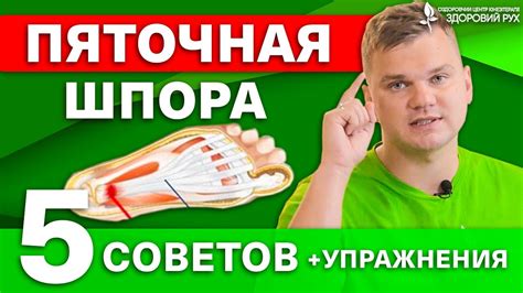 Пяточная шпора, как избавиться от боли. - YouTube