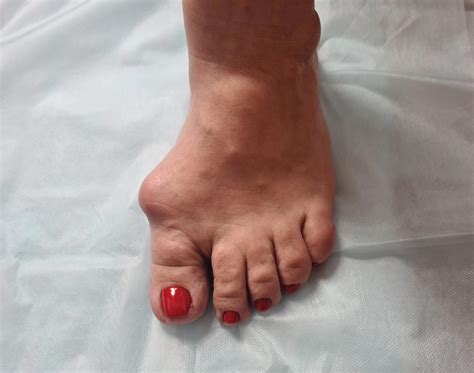 Take Care: Minimally invasive surgery can beat your bunion problem