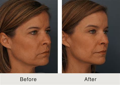 natural facelift carolina facial plastics
