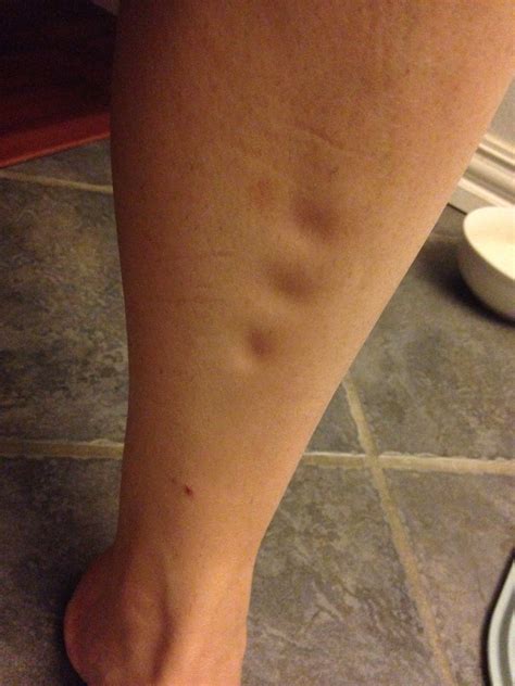 pitting edema vent  bump