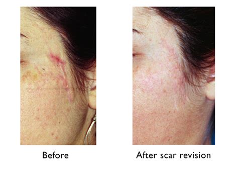 Cut Scar Plastic Surgery at Sophie Olsen blog
