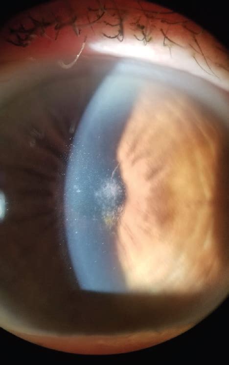 anterior basement membrane dystrophy  cataract surgery openbasement