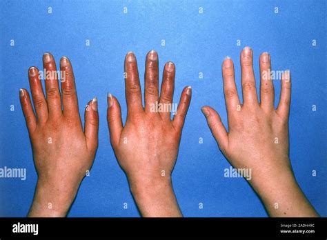 Acrocyanosis. View of hands suffering from acrocyanosis being compared ...
