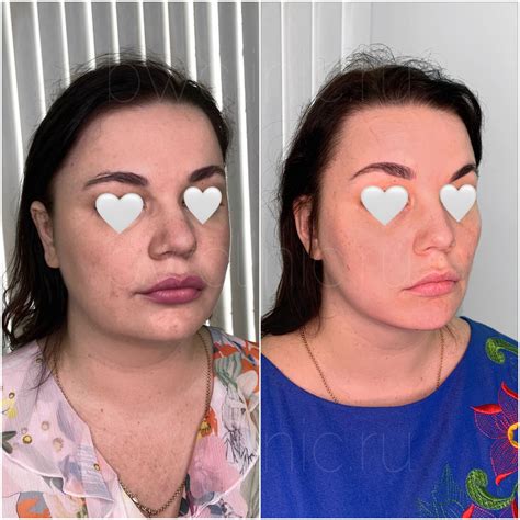Процедуры инъекции липолитиков от 2490 руб/мл - BeautyWay Clinic 8 (499 ...