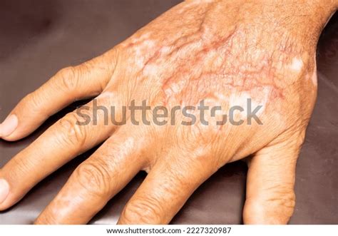 burn scars  hands picture scar stock photo  shutterstock