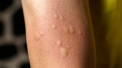 Hives Getting Worse Instead of Better: Causes and Treatment - GoodRx