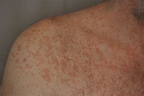 Pitiriasis versicolor - DocCheck