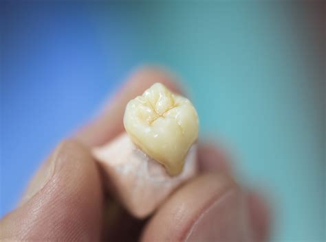 Dental Prosthesis – Dentisis
