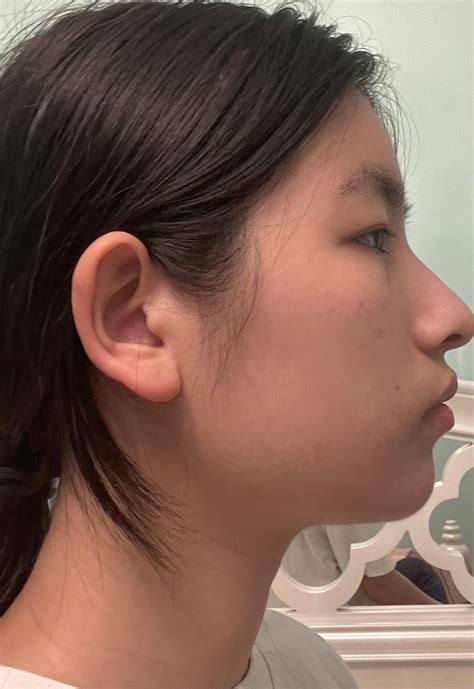 Do I have a recessed jaw? If so, what can I do to fix it? : r/jawsurgery