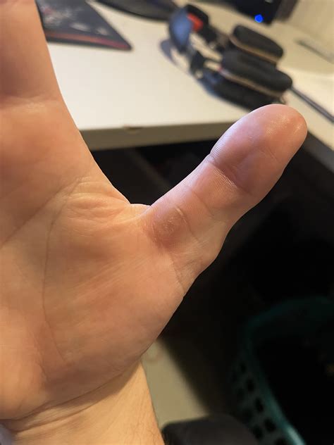 New ergonomic devices will likely prevent a chronic twitching thumb issue 24