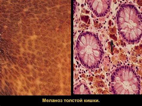 Меланоз толстой кишки: причины, симптомы, диагностика и лечение