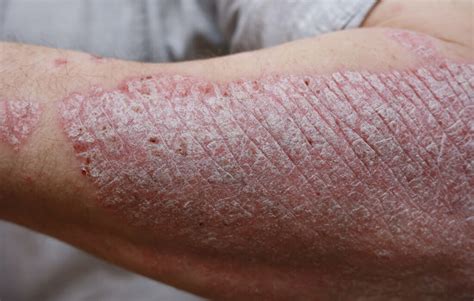 Quels sont les types de psoriasis et comment les gérer
