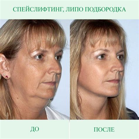 Эндоскопическая подтяжка лица - что это, как делается, чего ожидать и