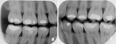 About Your Teeth What are bitewing x-rays? - About Your Teeth