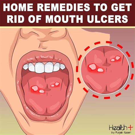 3 Surprising Fixes For The Painful Throat Ulcer Blues