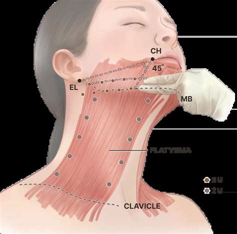 Nefertiti Lift: Benefits, Risks and Effects | SEV