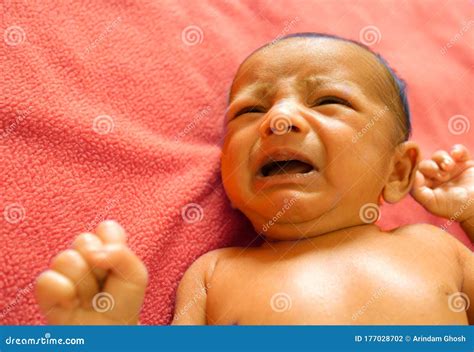 Neonatal Jaundice - Yellowish Discoloration Of The White Part Of The Eyes And Skin In Newborn ...