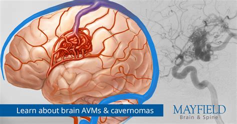 Arteriovenous malformation (AVM)