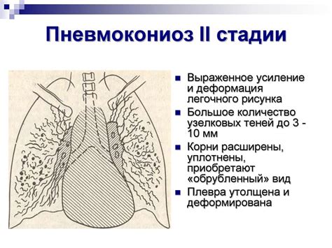 Общие понятия о пылевых болезнях легких. Пневмокониозы - презентация онлайн