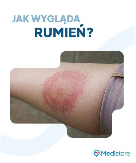 Borelioza – objawy, przyczyny i leczenie | Medistore