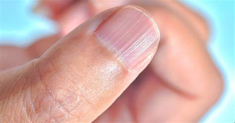 8 Symptoms of Iron Deficiency Anemia – Nutrifactor