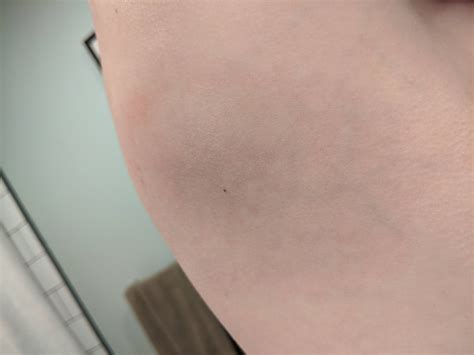 UPDATE: Strange abrasion under my shoulder blade. Fading! Now it's just