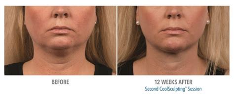 CoolSculpting before and after | Real Patient Photos - Vein & Laser ...